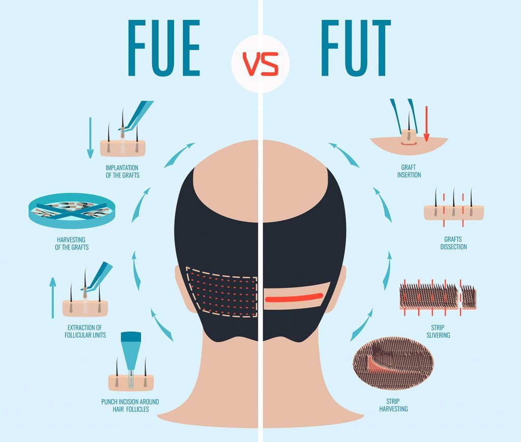 همه چیز درباره روش انحصاری C.FUE