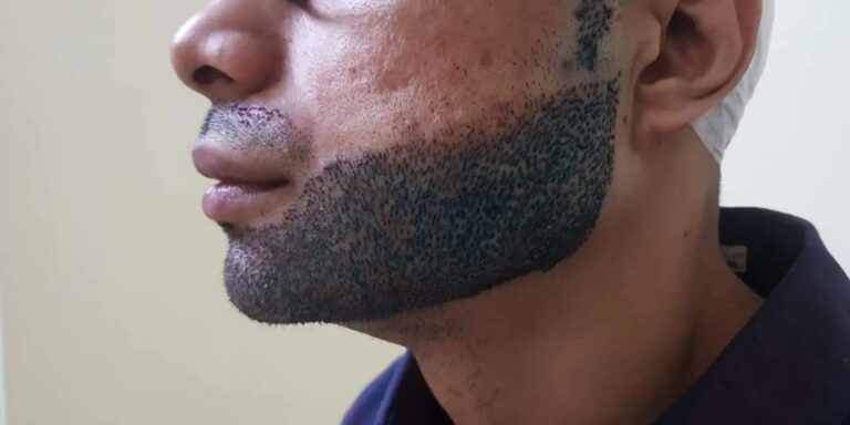 همه چیز درباره کاشت ریش و سبیل