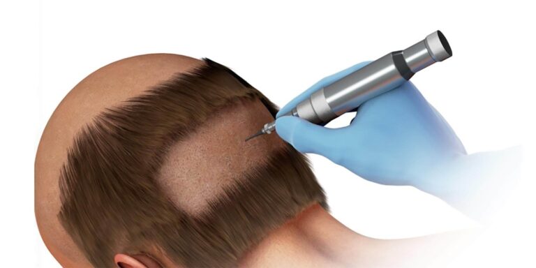 همه چیز درباره روش انحصاری C.FUE