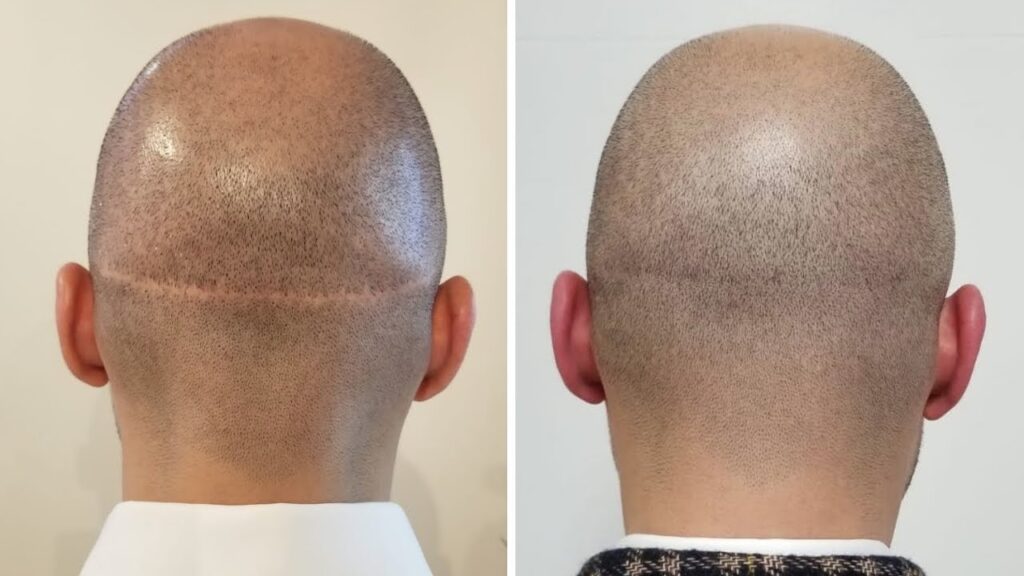 کاشت مو روی جای زخم، بخیه و اسکار