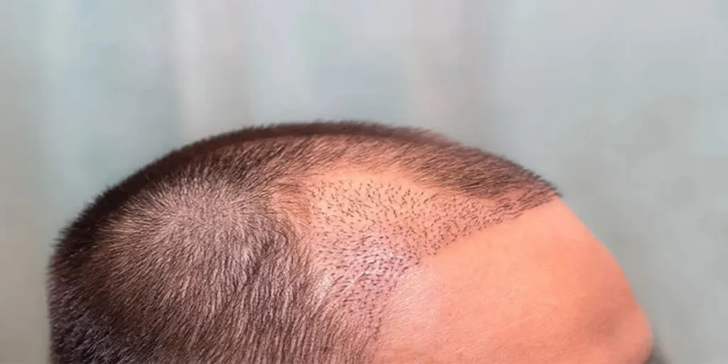 مراحل کاشت مو به زبان ساده و همراه با جزئیات کامل