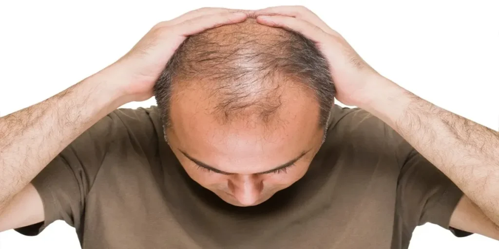 کاشت مو به سبک مردانه