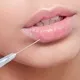 رضایت بیمار از فیلر لب در کلینیک سپهر