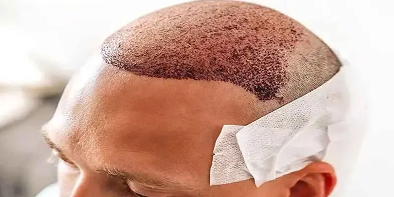 جدیدترین روش کاشت مو