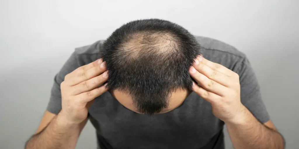 کاشت مو از ناحیه تناسلی