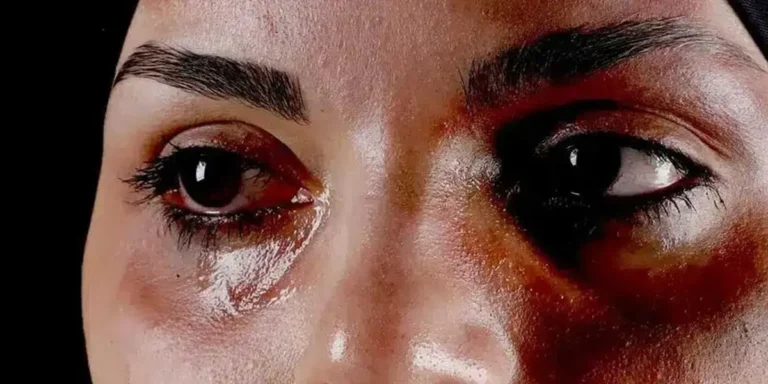 قرص برای کاهش ورم صورت بعد از کاشت مو