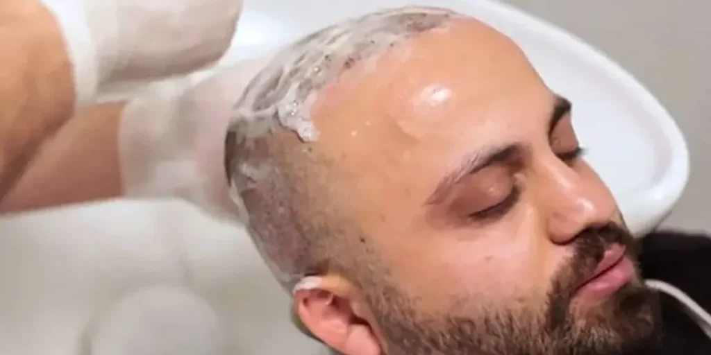 بهترین شامپو فوم بعد از کاشت مو