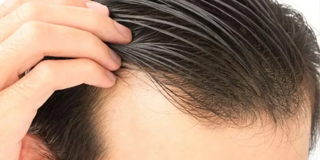 سیگار و مشروب بعد از کاشت مو: تاثیرات و نکات مهم برای مراقبت از پیوند مو