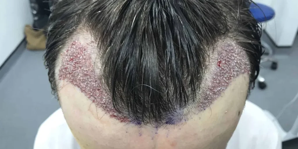 برداشت مو از ریش برای کاشت موی سر