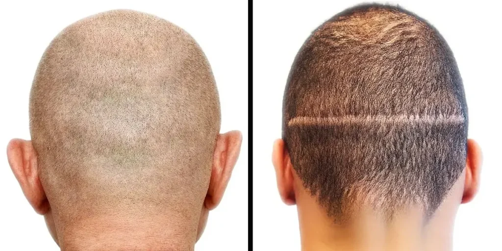 کاشت مو به روش fit یا fut