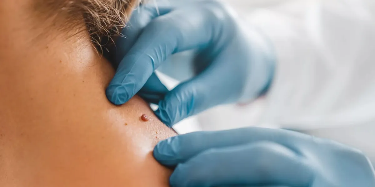 جراحی های کوچک پوست | جراحی های تخصصی سرپایی