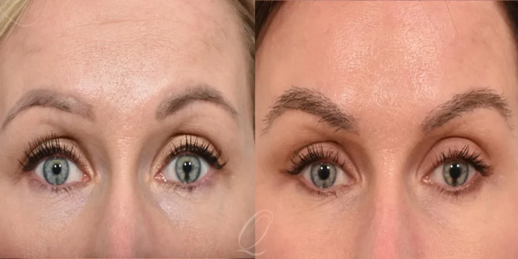 کاشت ابرو بدون جراحی