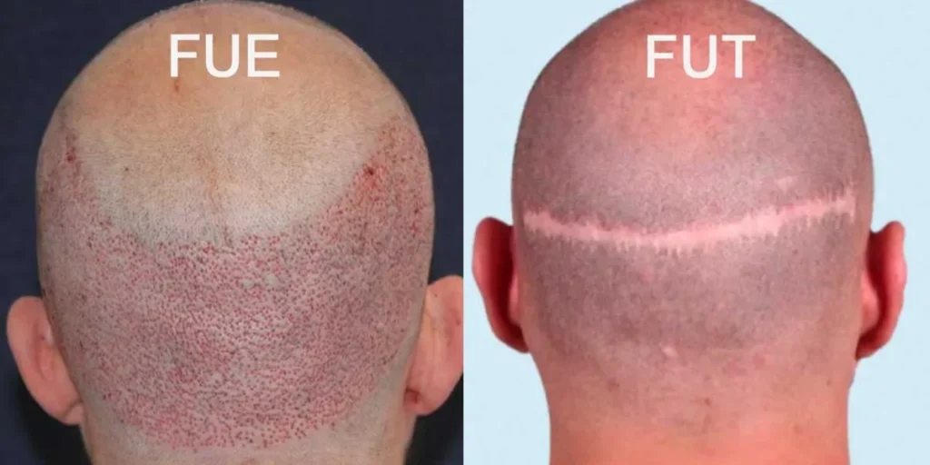 کاشت مو به روش fit یا fut