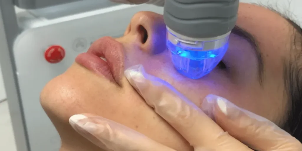 Comparing Plasma Therapy with Fractional RF