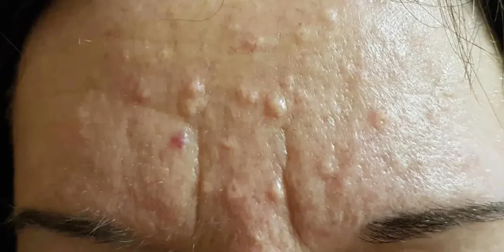 هیپرپلازی سباسه چیست و چگونه درمان میشود؟