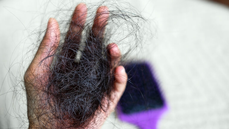علل ریزش موی ارثی