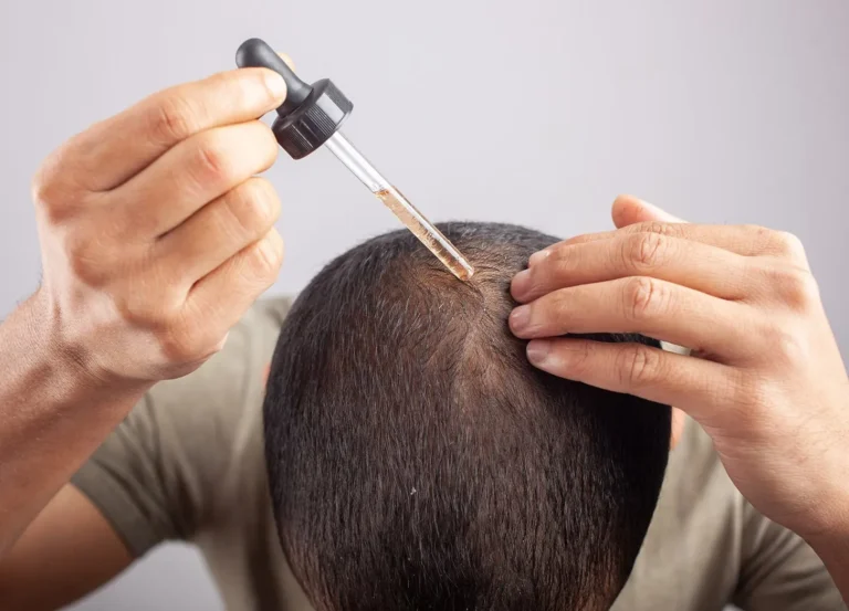 فیناستراید موضعی برای ریزش مو؛ آیا از قرص فیناستراید بهتر است؟