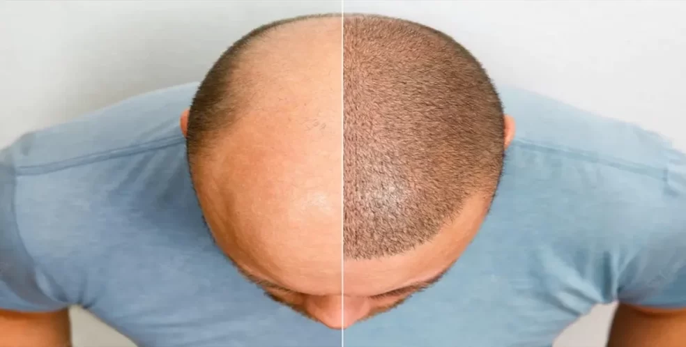 سن کاشت مو